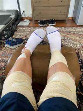Les jambes bandées du résident de Singapour Graham George Spencer, qui a été attaqué par une meute de loutres aux jardins botaniques de Singapour, sont vues, le 30 novembre 2021.
