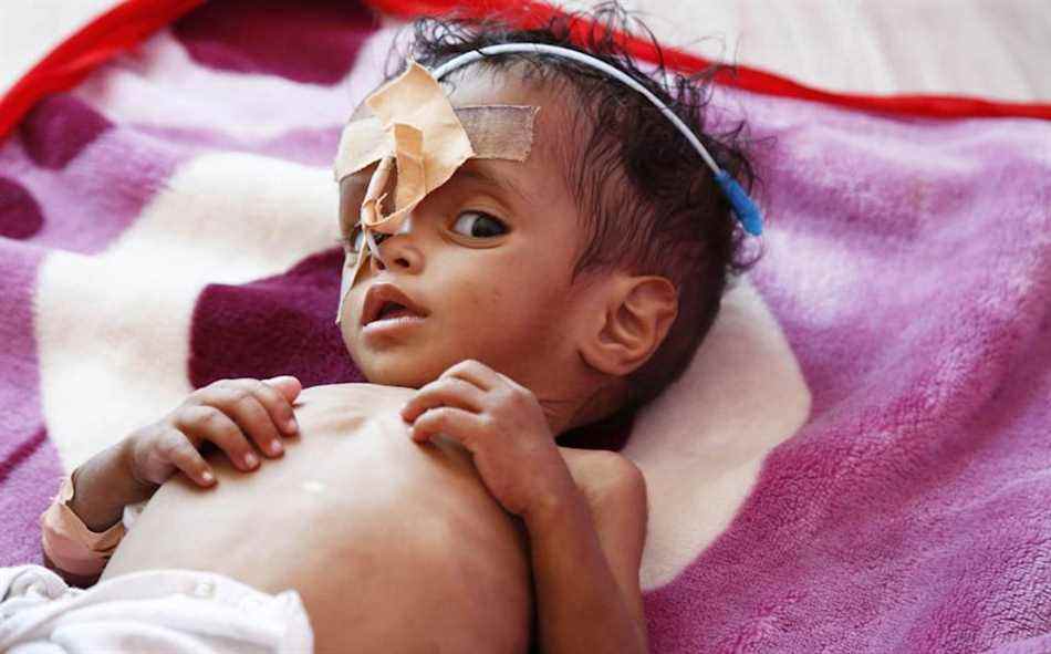Un nourrisson souffrant de malnutrition reçoit un traitement à l'hôpital Sabeen de Sanaa, au Yémen - Agence Anadolu 