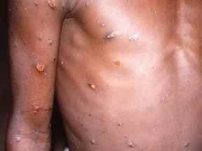 Une image créée lors d'une enquête sur une épidémie de monkeypox, qui a eu lieu en République démocratique du Congo, de 1996 à 1997, montre les bras et le torse d'un patient présentant des lésions cutanées dues au monkeypox, dans cette image non datée obtenue par Reuters le 18 mai 2022.