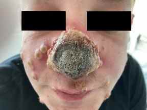 Le nez pourri d'un homme suite à un diagnostic de monkeypox et d'IST gravement non diagnostiquées.  (Boesecke, C., Monin, MB, van Bremen, K., Schlabe, S., Hoffman, C./Infection)