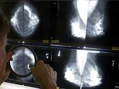 400 000 mammographies de moins pendant la pandémie, un cancer plus avancé maintenant observé: OMA