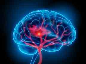 Une illustration du cerveau humain avec un symptôme d'AVC.