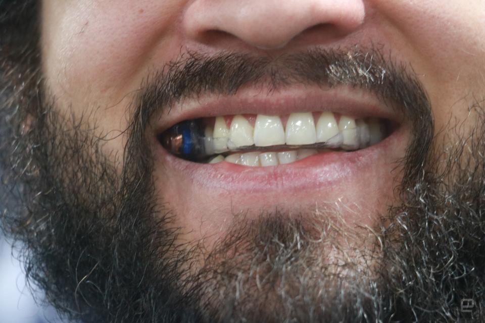 Gros plan sur le sourire d'une personne portant le MouthPad 2024. Certaines lignes indiquent que la personne a une gouttière transparente sur ses dents, tandis qu'un petit équipement se trouve au-dessus d'une dent du côté droit de sa bouche.